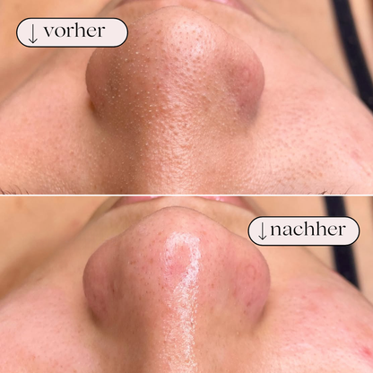 PureGlow - AquaFacial Skin Cleansing Device 