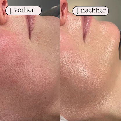 PureGlow - AquaFacial Skin Cleansing Device 